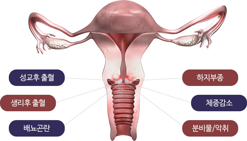 자궁경부암 증상 : 성교후 출혈, 생리후 출혈, 배뇨곤란, 하지부종, 체중감소, 분비물/악취